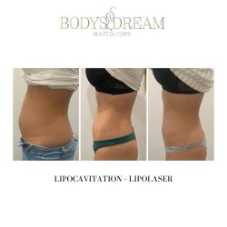 Bodys Dream - Drainage Renata França - Lipocavitation - Hydrafacial - Maderothérapie
