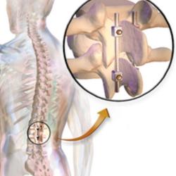 Chirurgie De Fusion Vertébrale à Faible Coût En Inde