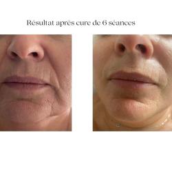 Cryo'form  - Expert Jet Peel - Lorient