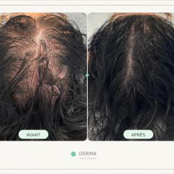Derma Treatment - Expert En Tricopigmentation Capillaire