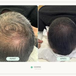 Derma Treatment - Expert En Tricopigmentation Capillaire