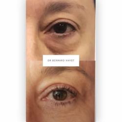 Dr Bernard Hayot - Blépharoplastie & Lipofilling Du Regard