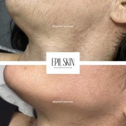 Epil Skin