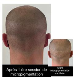 G&g Micropigmentation Capillaire - Tricopigmentation - Traitement Calvitie