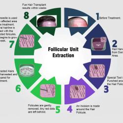 Hair Transplant Paris