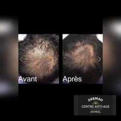 Jetpeel Biarritz - Centre Anti-âge Dermao