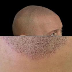 Khimaera Micropigmentation Capillaire (tricopigmentation Bordeaux)