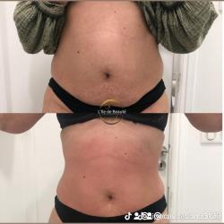 Melanie Morin - Lipocavitation à Domicile