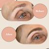 Brow-lift