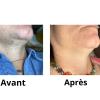 Résultats au bout de 10 mois de protocole