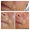 résultats de soins anti-âge du visage
