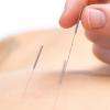 Taitement musculaire "Dry Needling", un sous-type de l'acupuncture