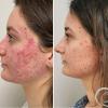 Avant / Après séance de microneedling Potenza contre l'acné