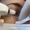 Traitement de Xanthélasma par technologie de plasma Plexr