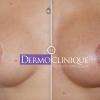 Dermographie médicale visant à camoufler les cicatrices d'une augmentation mammaire ou après une opération du cancer des seins. 
Objectif : Coloriser les aréoles et leur donner la même couleur tout en gardant un effet naturel. 