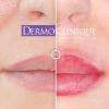 Maquillage permanent des lèvres. Colorisation par dermographie de la totalité des lèvres. <a href="http://dermoclinique.com/maquillage-permanent/4/1/HNYWC/maquillage-permanent-levres" title="maquillage permanent levres">