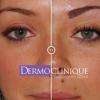 Maquillage permanent sourcils selon la technique POIL à POIL de Dermoclinique.