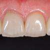 restauration esthétique du sourire via des facettes en céramique feldspathique