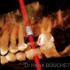 implant court sous sinusien. Dr BOUCHET implantologie grenoble