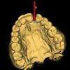 Implantologie 3D Dr BOUCHET 38000 Grenoble