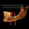 Implant en Bas Dr Bouchet Grenoble