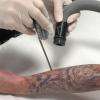 Détatouage laser au centre laser médical esthétique du Docteur Dubois à Angers.
