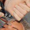 Séance de microneedling avec le Docteur Dubois à Angers.