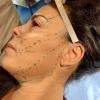 Tracé et calcul du trajet des fils tenseurs permanents par le Dr Foumentèze avant lifting visage, lifting sourcils et lifting double menton et cou.