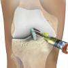 Injections de P.R.P. (Plasma Riche en Plaquettes) pour soulager les douleurs de l'arthrose, lésion d’un tendon, lésion musculaire ….