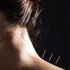 Acupuncture Nantes