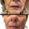 Résultat après un soin complet au plasma russe
Avant : rides marquées, traits fatigués, peau relâchée
Après : rides visiblement atténuées, peau repulpée, visage plus lisse et éclatant ✨
Le plasma russe stimule naturellement la production de collagène pour lisser les rides et redonner du volume sans injection.