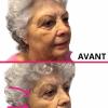 Résultat après un soin anti-rides au plasma russe
Avant : rides marquées, peau relâchée, perte de fermeté
Après : peau plus lisse, traits retendus, rides estompées ✨
Le plasma russe stimule naturellement la production de collagène pour raffermir la peau et atténuer les signes de l’âge, sans injection.