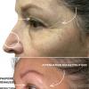 Résultat après un soin visage complet au plasma russe
Avant : paupières tombantes, pores dilatés, ridules visibles
Après : regard rehaussé, grain de peau affiné, ridules estompées ✨
Le plasma russe booste naturellement la fermeté de la peau et relance le renouvellement cellulaire pour un effet lifté sans chirurgie.

