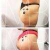 Séances de lifiting Colombien pour éliminer la cellulite et tonifier les fesses, Castelnau le Lez (34170)