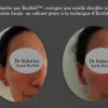 Otoplastie - chirurgie esthétique à Nice par le chirurgien Henry Sabatier