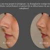 Rhinoplastie - chirurgie esthétique à Nice par le chirurgien Henry Sabatier