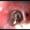 Fibroscopie