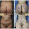 ????LIPOFILLING FESSIER BBL????
----------------------------------------------------------------------
☎️Contactez-nous pour un Devis gratuit et personnalisé
Whatsapp + 216 52 86 96 96
France ???????? +33 756 756 824
Canada ???????? +1 587 604 9050
???? devis@wellbe-esthetique.com
-------------------------------------------------------------------------
➡️FB: facebook.com/wellbetunisie
➡️INST: instagram.com/wellbe_chirurgie_esthetique
????http://www.wellbe-esthetique.com/
-------------------------------------------------------------------------
#wellbe #chirurgieesthetique #lipofilling #brazilianbutt #fesses #lipofillingfessierstunisie #lipofillingfessiers #lipofillinbbl #wellbechirurgieesthetique #santé #health #perfectlook #chirurgie #surgery #luxury #tourismeesthetique #travel #tunisia #tunisie #france #paris #marseille #canada